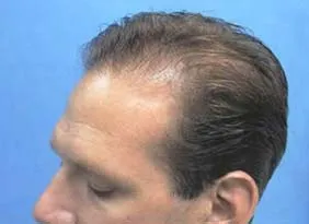 Josh Engoren before hair transplant