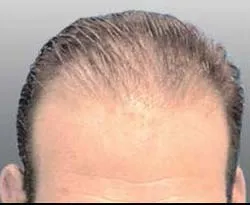 Josh Engoren before hair transplant