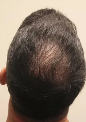 Nick Alberto crown view at 9 months