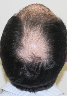 Nick Alberto crown view before hair transplant