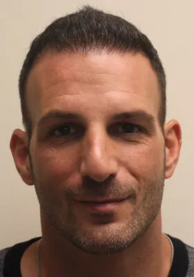 Nick Alberto hair transplant front view at 9 months