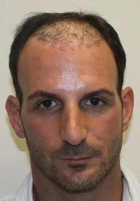 Nick Alberto hair transplant before front view