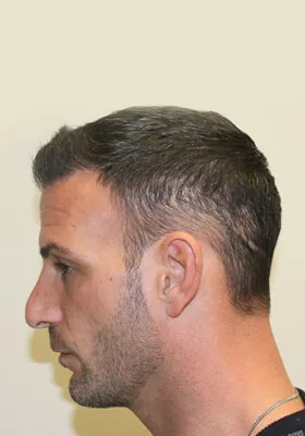 Nick Alberto left side view at 9 months