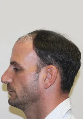 Nick Alberto left side view before hair transplant