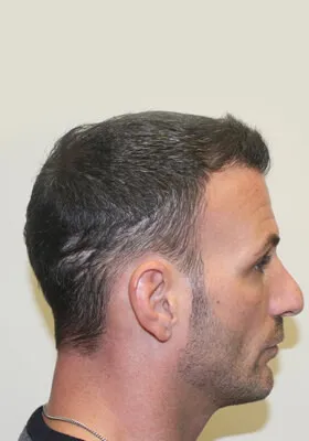 Nick Alberto hair transplant right side view at 9 months