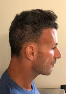 Nick Alberto latest right side hair restoration view