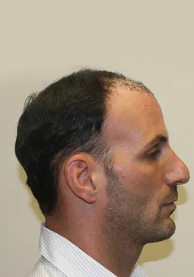 Nick Alberto hair transplant before right side view