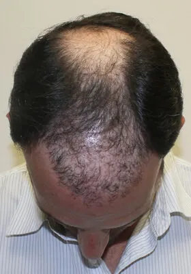 Nick Alberto tilt view before hair transplant
