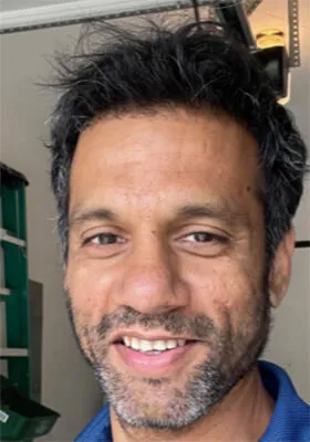 Srini at one-year hair transplant follow-up