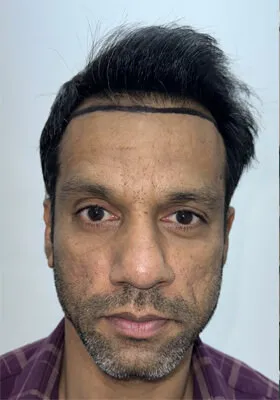 Srini before hair transplant