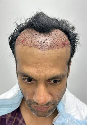Srini immediately after hair transplant graft placement