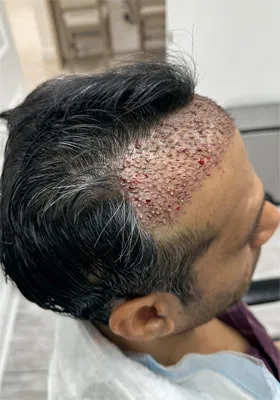 Srini right side immediately after hair transplant graft placement