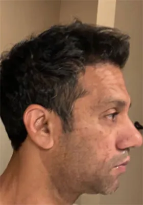 Srini right side at one-year hair transplant follow-up