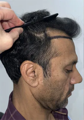 Srini right side before hair transplant