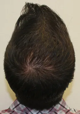 Ryan Hair Transplant Crown View After Second Procedure