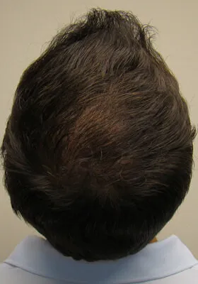 Ryan Hair Transplant Crown View at 1 Year