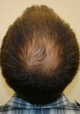 Ryan Hair Transplant Before Crown View