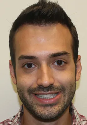 Ryan Hair Transplant Front View After Second Procedure
