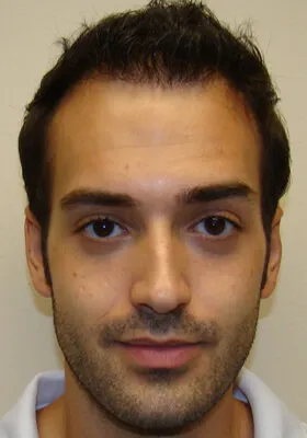 Ryan Hair Transplant Front View at 1 Year