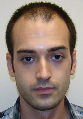 Ryan Hair Transplant Before Front View