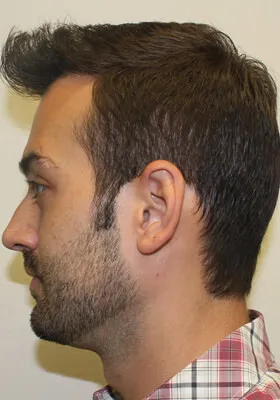 Ryan Hair Transplant Left Side View After Second Procedure