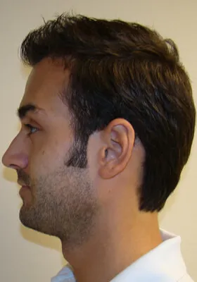 Ryan Hair Transplant Left Side View at 1 Year