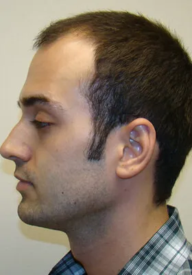Ryan Hair Transplant Before Left Side View