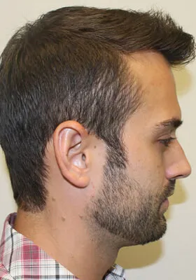 Ryan Hair Transplant Right Side View After Second Procedure