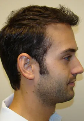 Ryan Hair Transplant Right Side View at 1 Year