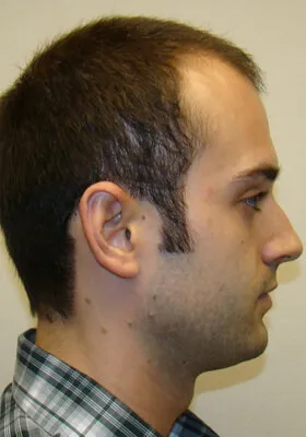 Ryan Hair Transplant Before Right Side View
