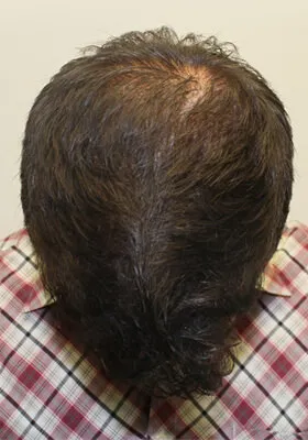 Ryan Hair Transplant Tilt View After Second Procedure