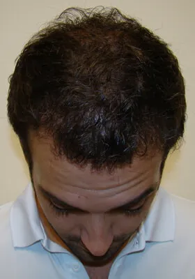 Ryan Hair Transplant Tilt View at 1 Year