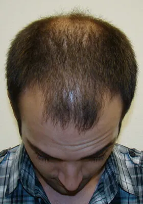 Ryan Hair Transplant Before Tilt View