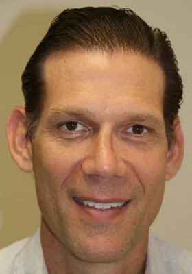 Josh Engoren front view at 10 months after hair transplant