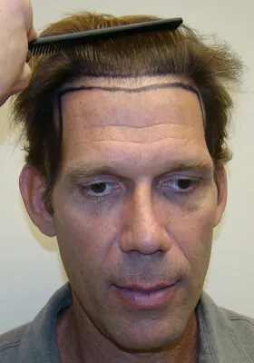 Josh Engoren front view before hair transplant