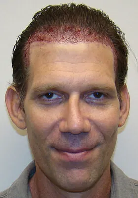 Josh Engoren front view immediately after graft placement