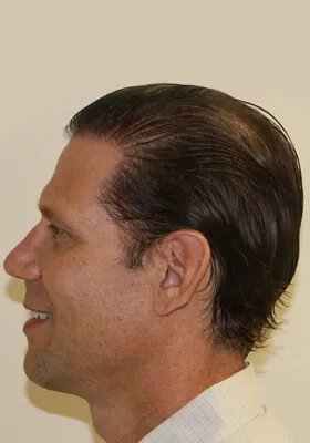 Josh Engoren left profile at 10 months after hair transplant