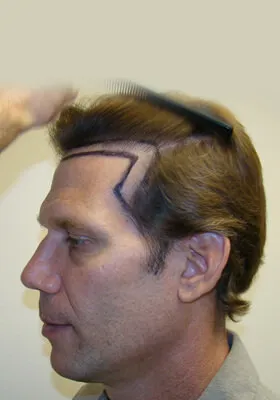 Josh Engoren left profile before hair transplant