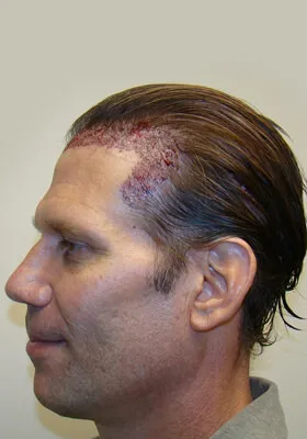 Josh Engoren left profile immediately after graft placement
