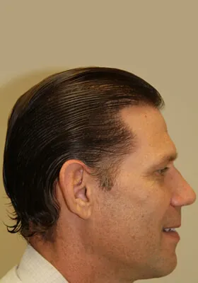 Josh Engoren right profile at 10 months after hair transplant
