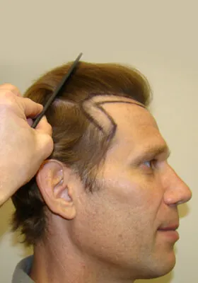 Josh Engoren right profile before hair transplant