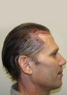 Josh Engoren right profile immediately after graft placement