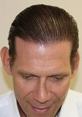 Josh Engoren tilt view at 10 months after hair transplant