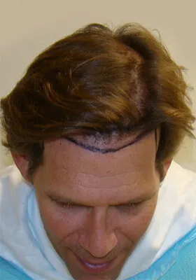 Josh Engoren tilt view before hair transplant
