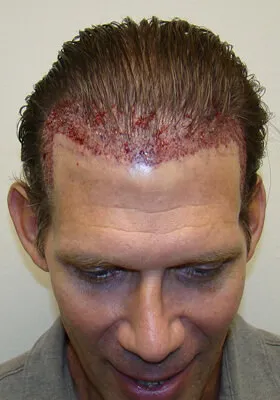 Josh Engoren tilt view immediately after graft placement