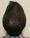 Ryan Crown View - 2nd Procedure