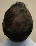 Ryan Crown View - 1st Surgery