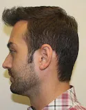 Ryan Left View - 2nd Procedure