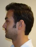 Ryan Left View - 1st Surgery