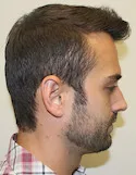 Ryan Right View - 2nd Procedure
